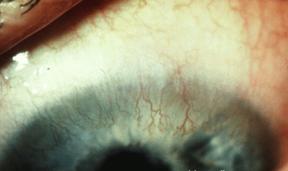 vascularización de cornea por lente de contacto